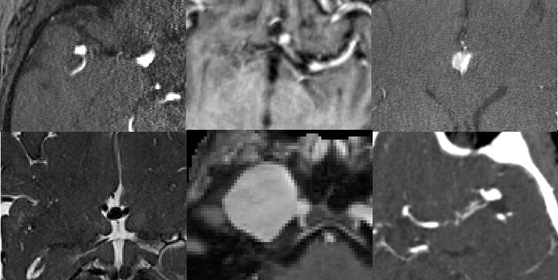 RSNA Intracranial Aneurysm Detection
