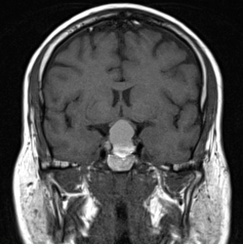 Brain Tumor MRI Classification